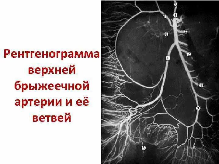 Синдром верхней брыжеечной артерии. Ветви верхней брыжеечной артерии схема. верхняя брыжеечная артерия анатомия кт. верхняя брыжеечная артерия ангиограмма. сегменты верхней брыжеечной артерии.