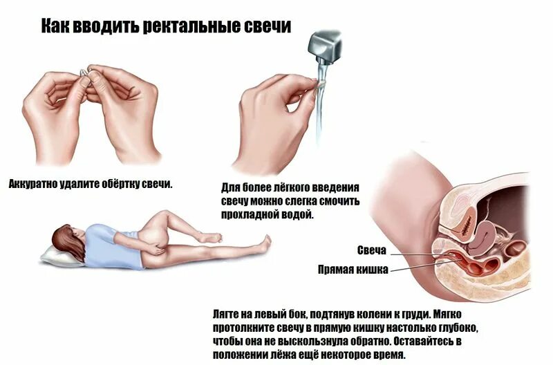 Как использовать свечи. Как вводить свечу в прямую кишку. как вставляют ректальные свечи фото. введение ректального суппозитория. как вставить свечку в анальное отверстие.