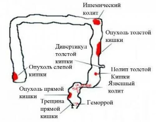 Стул с кровью у взрослого. Трещина в заднем проходе кровоточит