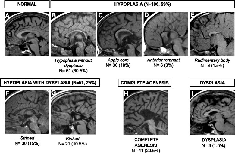 Гипоплазия червя. Corpus callosum MRI. Dysplasia Corpus callosum MRI.