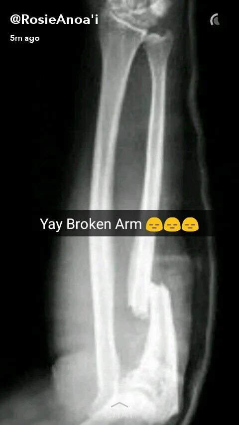 Radius fracture
