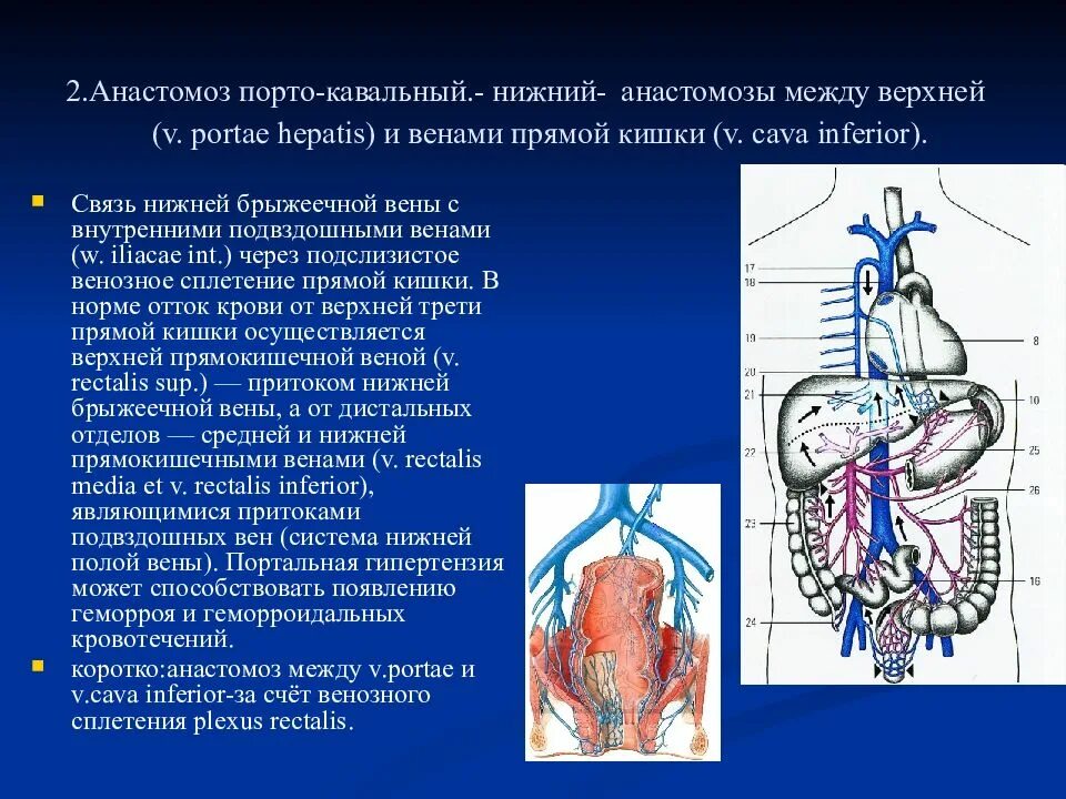 Нижний Порто кавальный анастомоз. Порто кавальные воротная Вена печени. Портокавальный кавальный анастомоз. Нижняя полая Вена нижняя брыжеечная Вена. Тромбоз вены печени