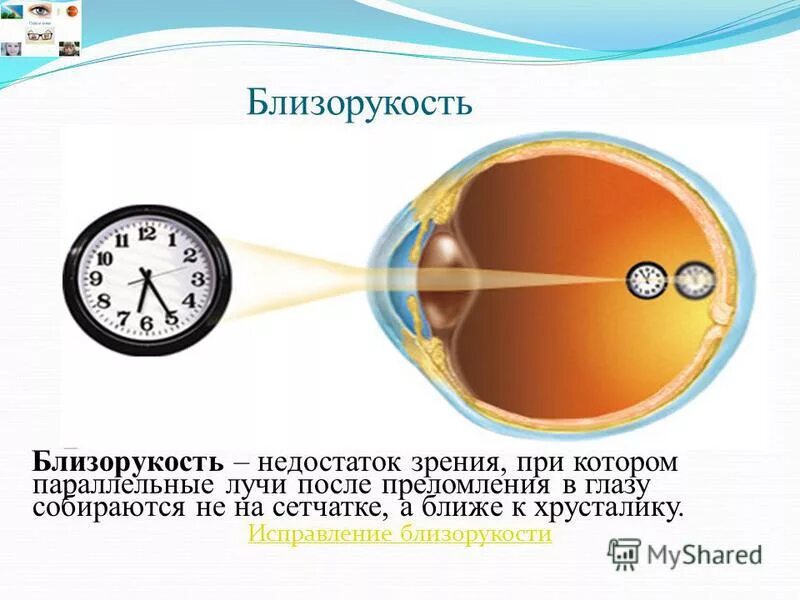 Слабая миопия глаза что. Близорукость. Зрение при близорукости. Близорукость миопия. Миопия или близорукость.