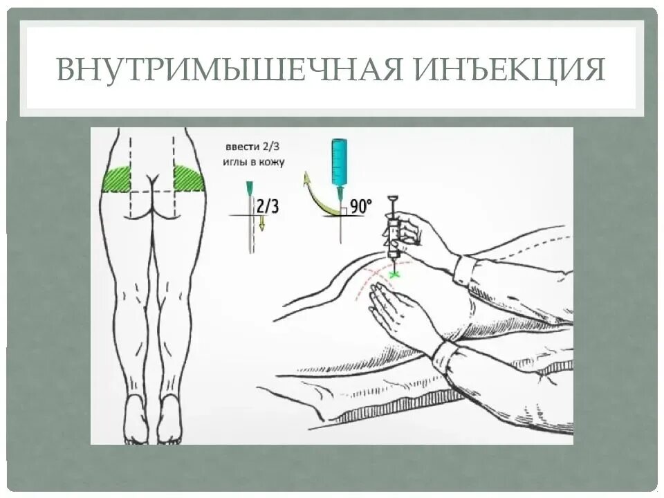 Методы уколов. Схема внутримышечных инъекций масляных растворов. Внутримышечная инъекция алгоритм. Введение внутримышечной инъекции в ягодицу алгоритм. Внутримышечная инъекция глубина введения иглы.