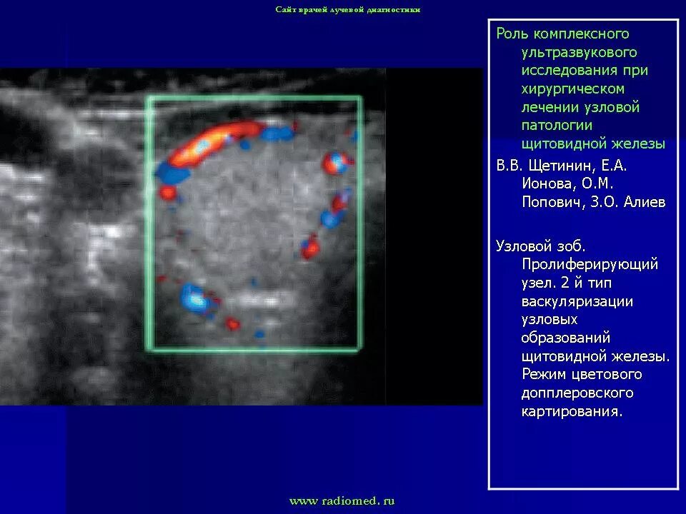 ЦДК кровоток щитовидной железы. Ультразвуковая картина щитовидной железы норма. Лимфатический узел щитовидной железы УЗИ. Щитовидная железа при УЗИ исследовании. Перинодулярный кровоток что это