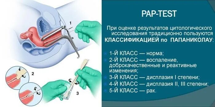 Кровит после цитологии шейки. Алгоритм взятия мазка по папаниколау (пап-тест).. цитология мазка шейки матки. цитология мазков pap тест. мазок на онкоцитологию пап тест.