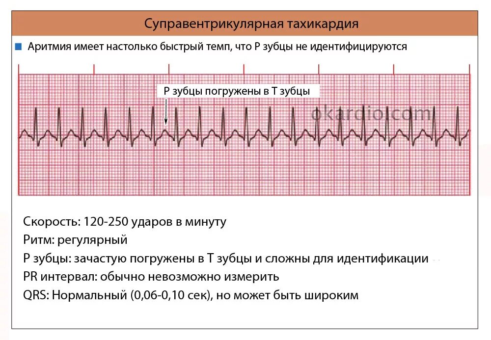 Экг тахикардия синусовый ритм. Пируэтная тахикардия клинические рекомендации. Веретенообразная желудочковая тахикардия экг. Аритмия предсердий пароксизмальная тахикардия. Аритмия и тахикардия чем отличаются.