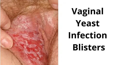 lesbian sex yeast infection.