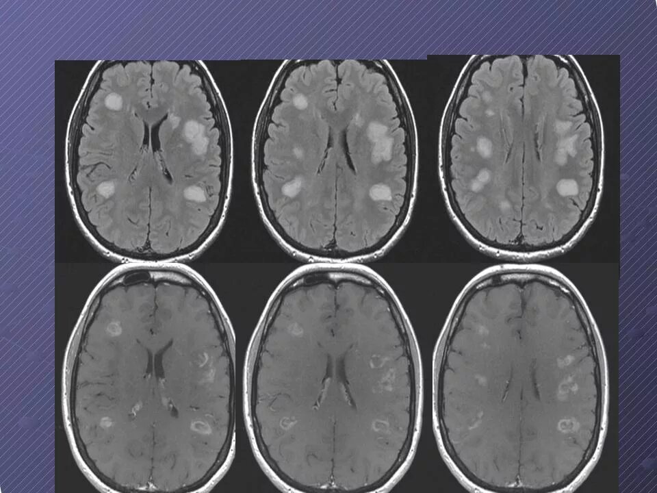 Многоочаговые поражения головного. Прогрессирующая мультифокальная лейкоэнцефалопатия кт. Болезнь Бинсвангера прогрессирующая лейкоэнцефалопатия. Мультифокальная лейкоэнцефалопатия мрт. Энцефалопатия Бинсвангера.