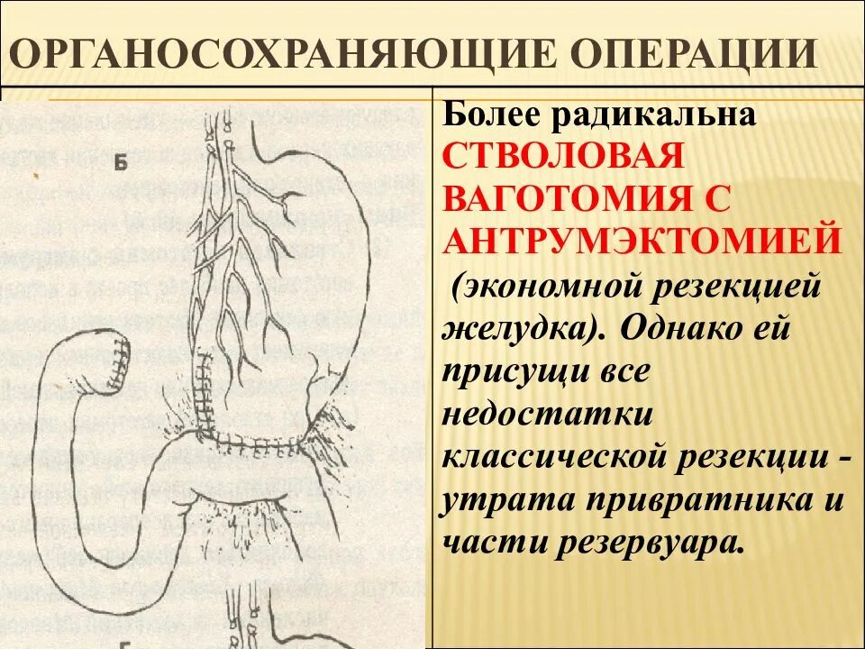 Ваготомия желудка при язвенной болезни. Органосохраняющие операции на желудке. Органосберегающие операции на желудке. Стволовая ваготомия с антрумэктомией. Осложнения желудка 12 перстной кишки