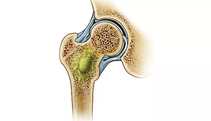 Гематогенный остеомиелит таз. Остеомиелит тазобедренного сустава. Острый Гнойный остеомиелит (гематогенный, травматический).. Гнойные заболевания суставов