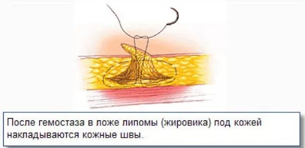 Удаление липомы новосибирск. Жировик в подкожно жировой клетчатке. Кистообразный жировик. Жировик народные средства. Удаление липомы новосибирск.