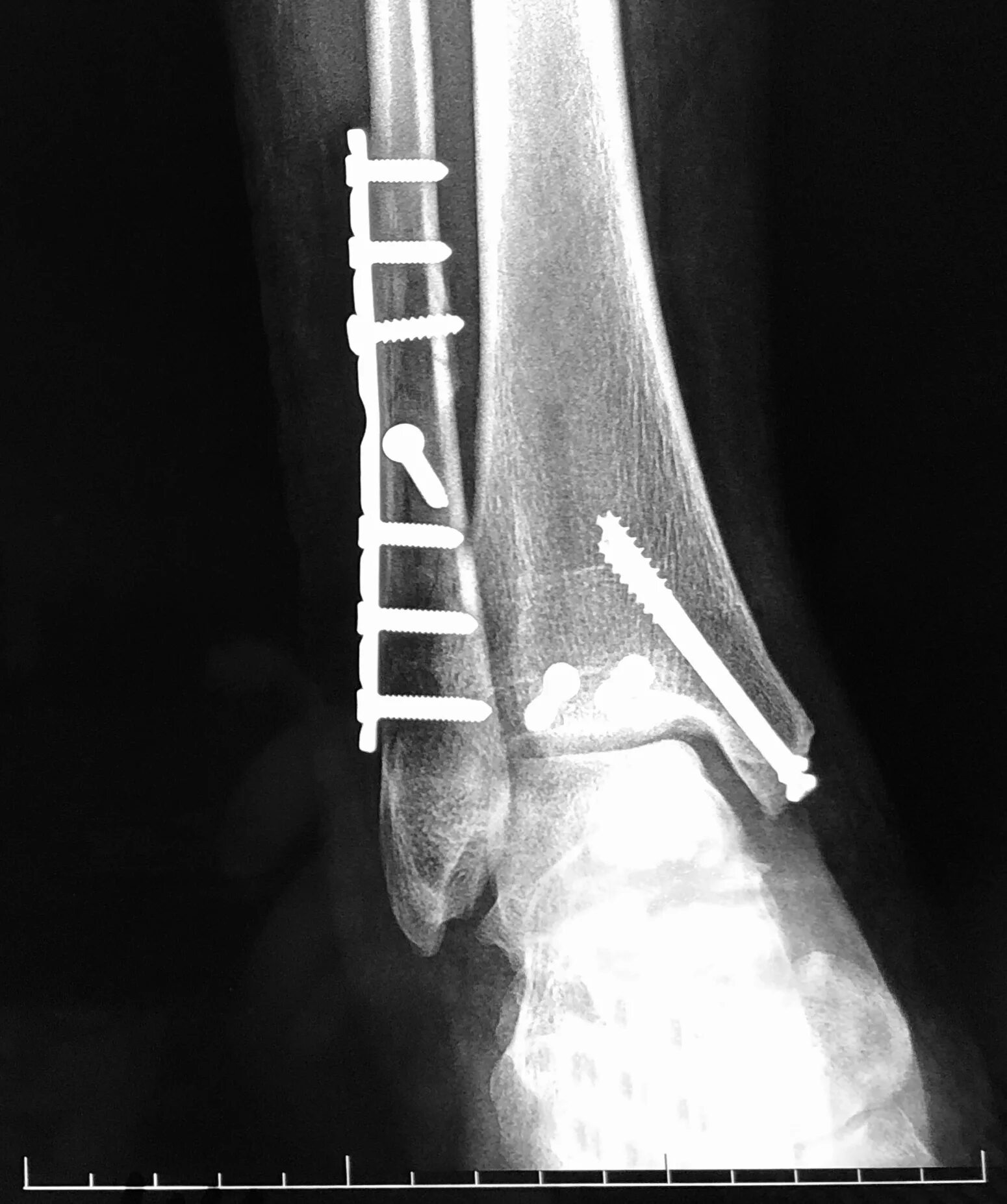 Broken cock. Перелом лодыжки с остеосинтезом. Остеосинтез перелома костей голени. Остеосинтез перелома берцовой кости. Чрескостный остеосинтез лодыжки.