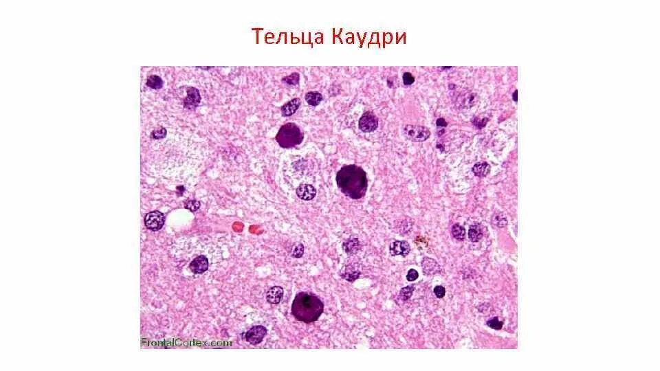 Многочисленные мелкие тельца. Тельца Коудри патанатомия. Тельца Гварниери цитология.