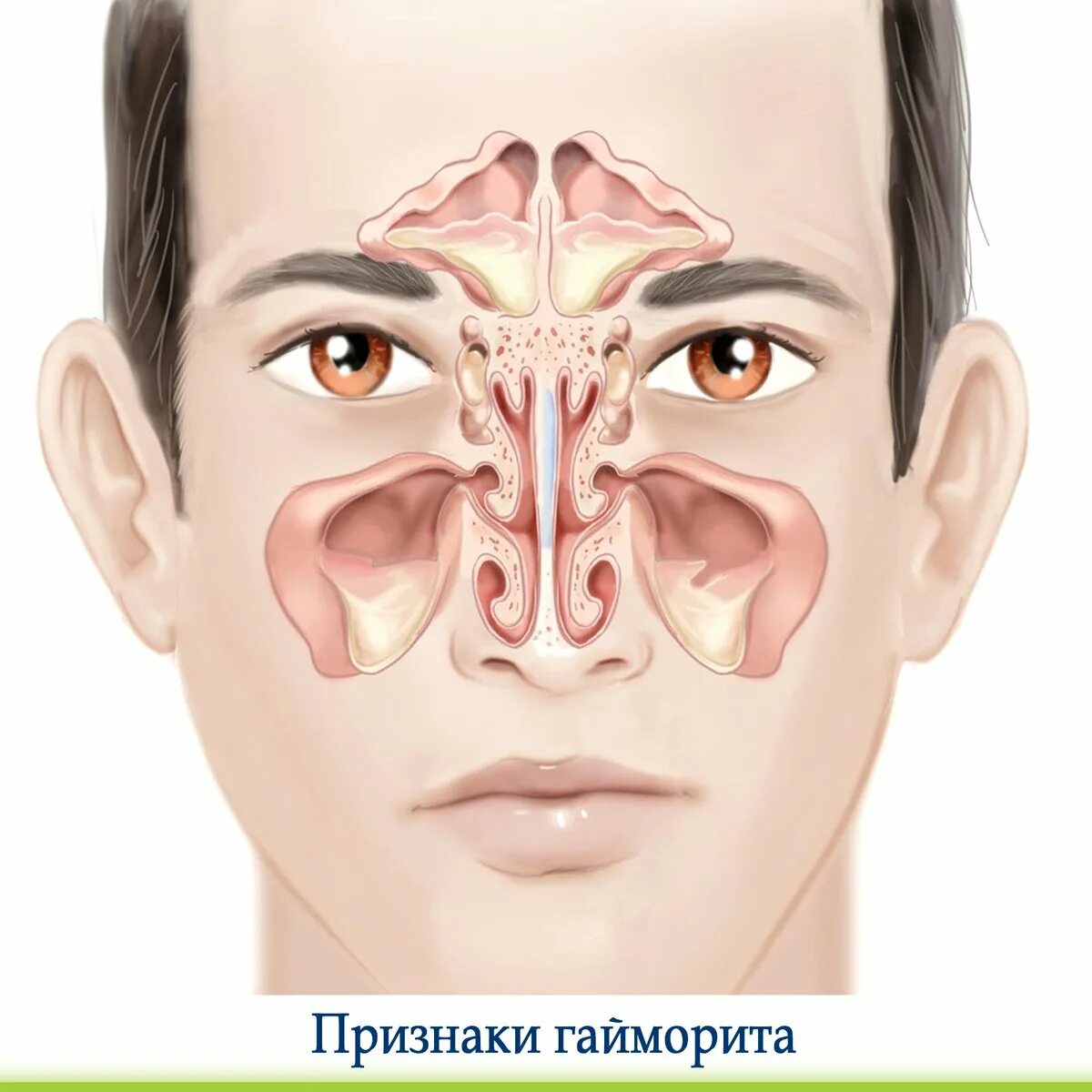 Долгая заложенность носа. Риносинусит острый риносинусит. Синусит верхнечелюстной пазухи. Гайморовы пазухи анатомия гайморит. Экссудативный пансинусит.