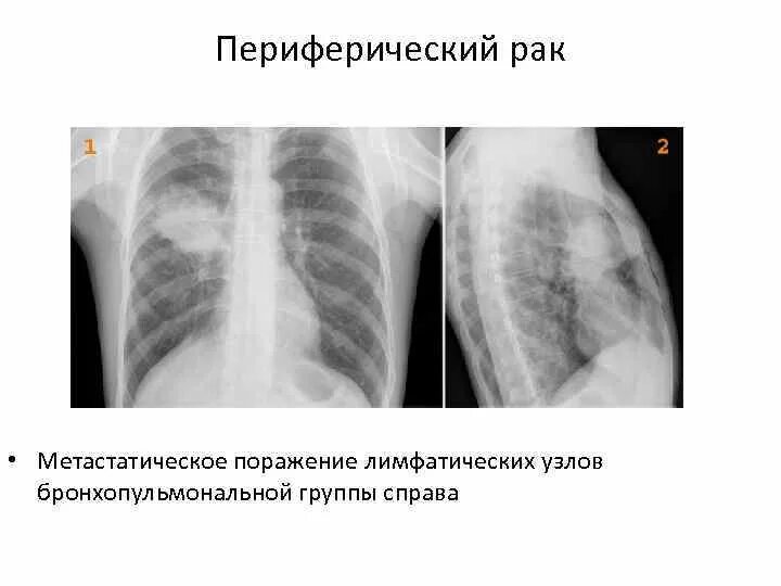 Метастатические опухоли легких. Рентгенодиагностика метастатического поражения легких. Метастазы в легкие рентген. Метастазы в легких лимфоузлы