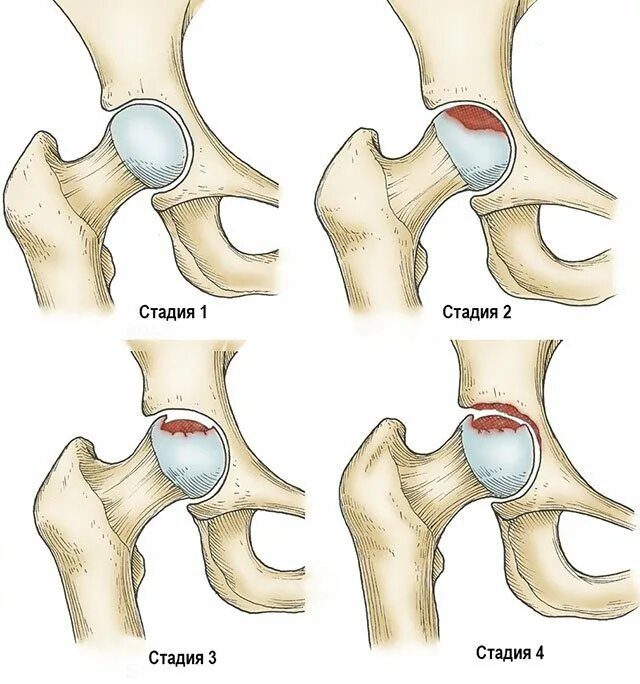 Больной сустав тазобедренный. Асептический некроз головки тазобедренного сустава стадии. Асептический некроз головки бедренной. Степени асептического некроза головки бедренной кости. Двухсторонний асептический некроз головки бедренной кости.
