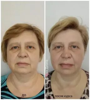 Витапластика лица что это такое отзывы