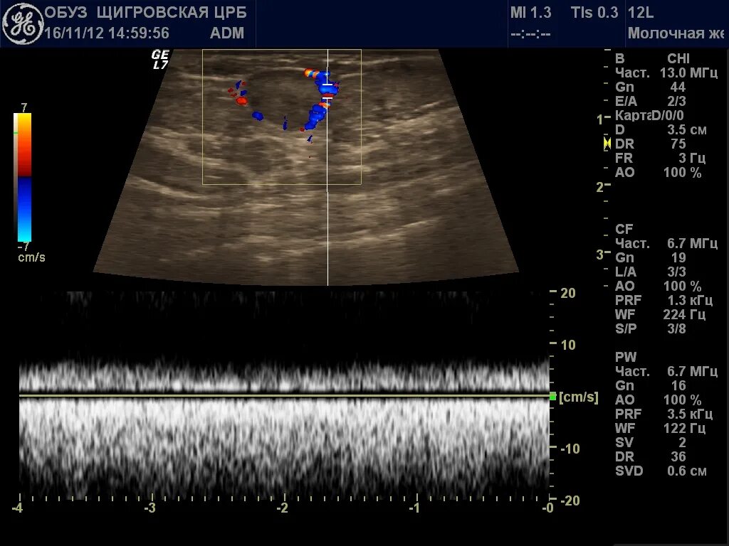 УЗИ молочных желез цветовое допплеровское картирование. ЦДК УЗИ молочных желез. Кровоток на УЗИ фиброаденома молочной железы. Перинодулярный кровоток молочной железы. Перинодулярный кровоток что это