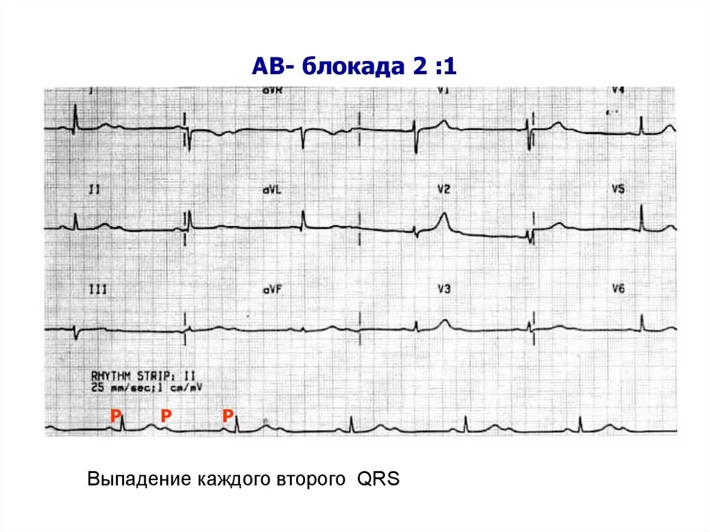 Блокада qrs. АВ блокада Мобитц 2 на ЭКГ. АВ блокада 2 степени Мобитц 1 на ЭКГ. АВ блокада 3 степени Мобитц 1. АВ блокада 2 степени 2 к 1.