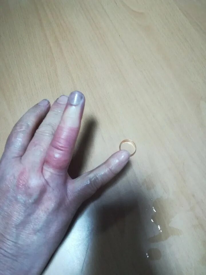 Опух палец где кольцо. Опух палец где кольцо