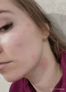 От прыщей на лице базирон