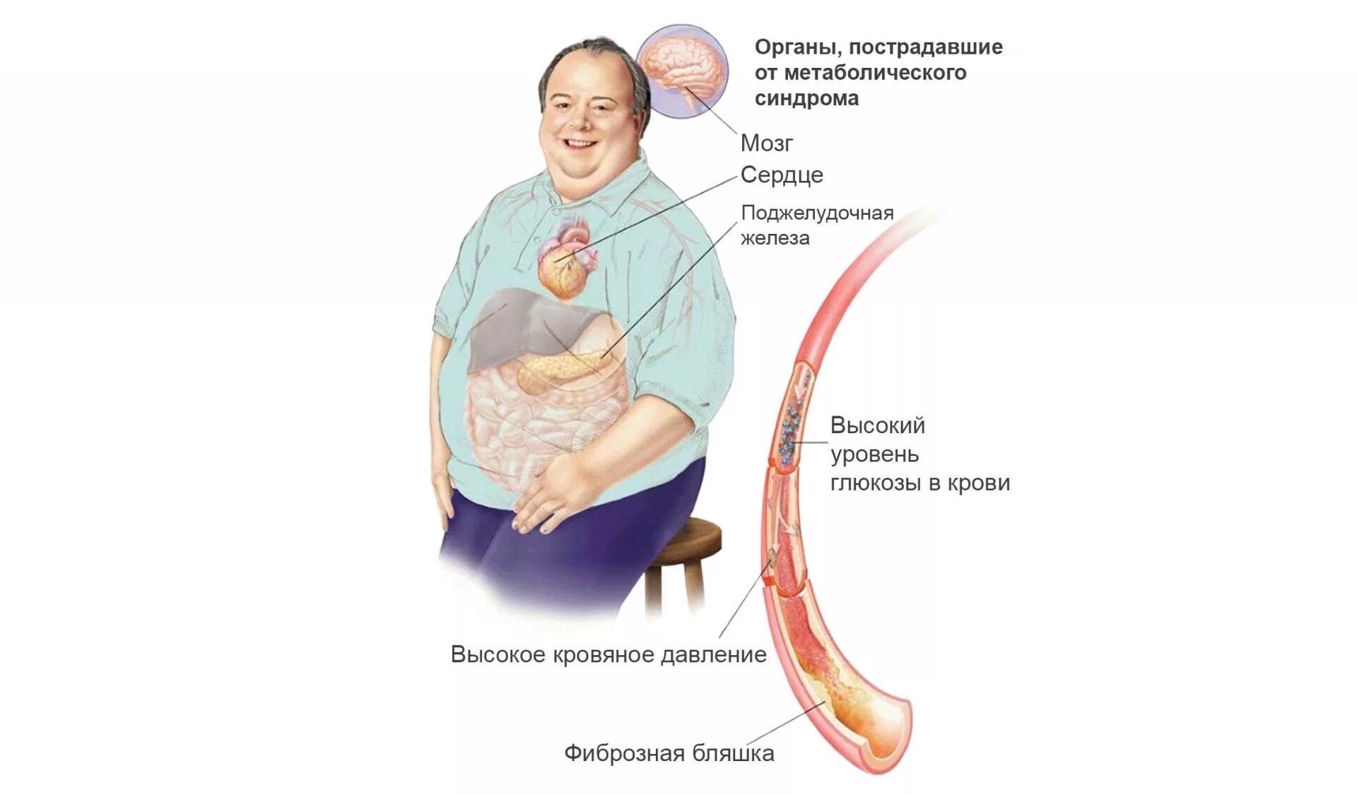 Синдром муна. Метаболический синдром. Ожирение внутренних органов. Абдоминальное ожирение.