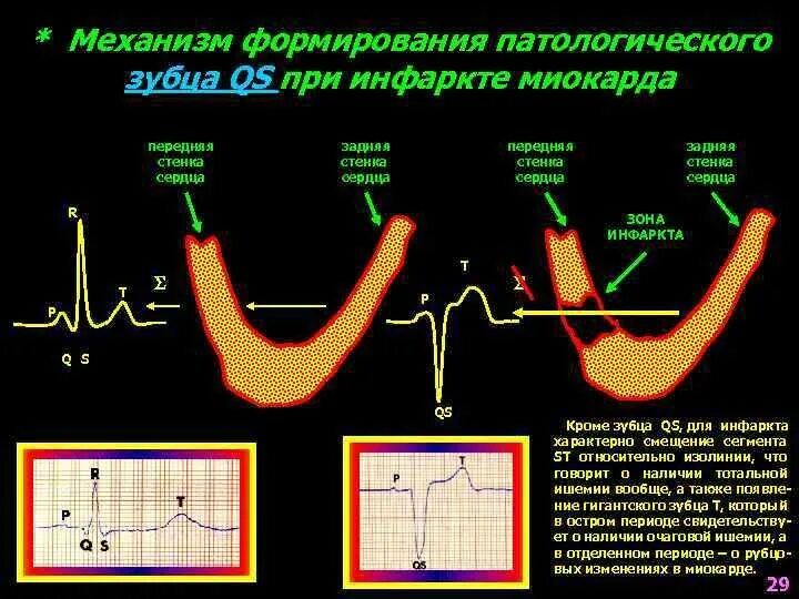 Изменение зубца q. Патологический зубец при трансмуральном инфаркте. Формирование патологического зубца q. Патологический зубец q при инфаркте. Признаки патологического зубца q.