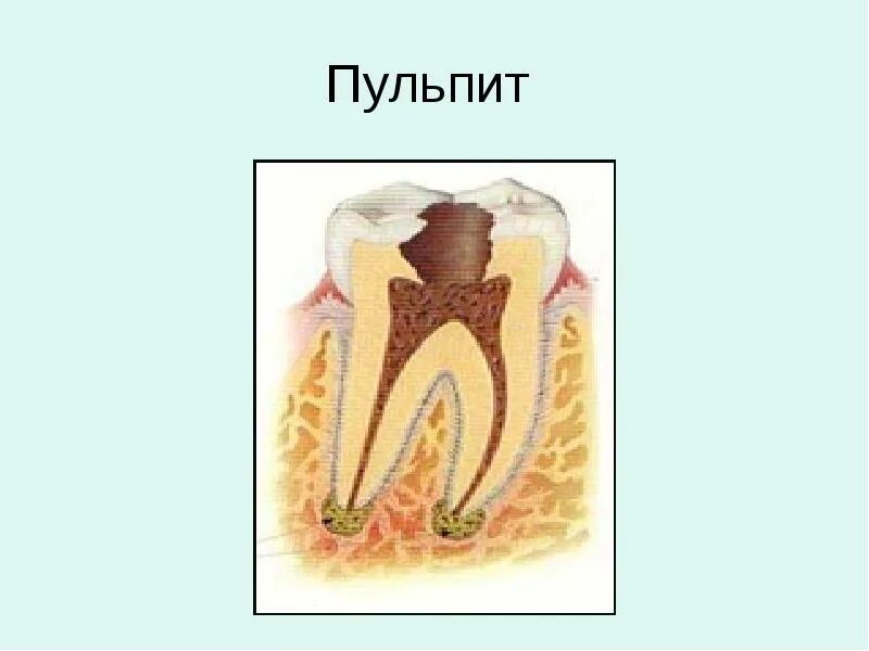 Пульпит сколько дней. Кариес пульпит периодонтит. презентация «кариес, пульпит, периодонтит».