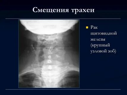 Рак трахеи