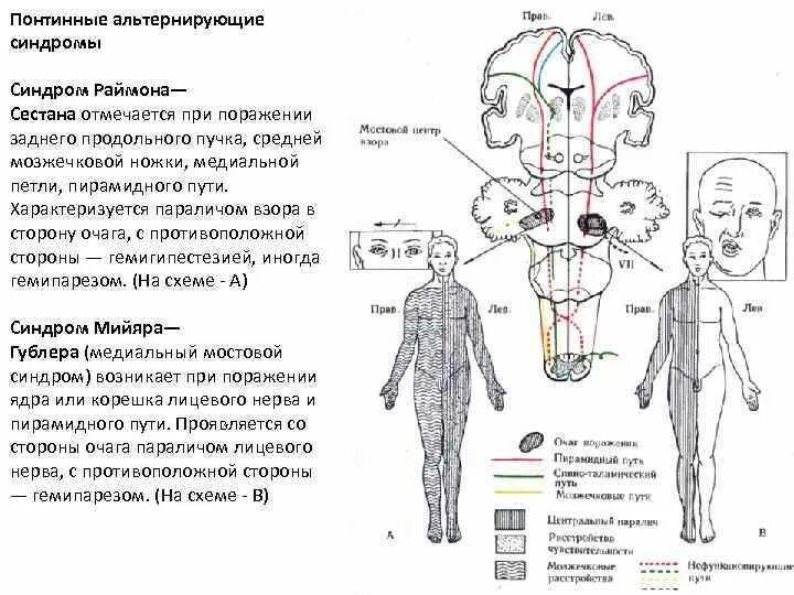 Оптико пирамидный синдром. Альтернирующие синдромы схемы. альтернирующий синдром раймона сестана. левосторонний центральный гемипарез очаг поражения. очаг поражения при гемипарезе.