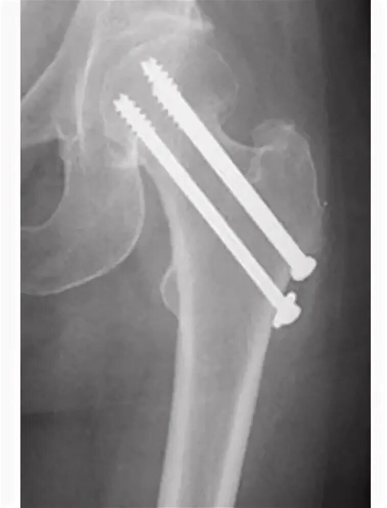Металлоостеосинтез перелома шейки бедра. Остеосинтез шейки бедра рентгенограмма. Остеосинтез перелома шейки бедра канюлированными винтами. Остеосинтез 3 канюлированными винтами шейки бедра.