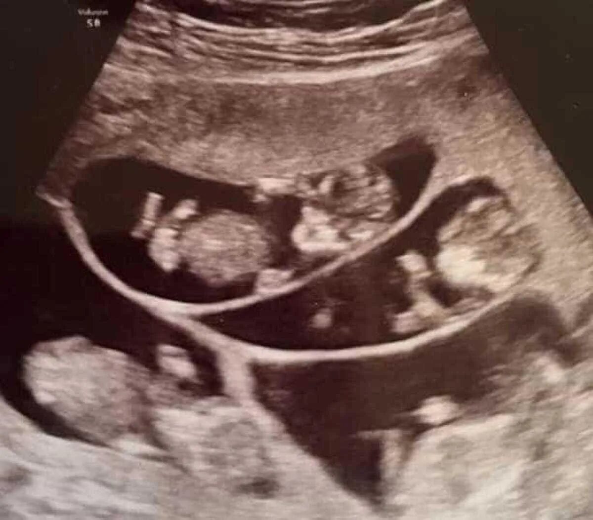 Двойня 13. Узи 12 недель беременности двойня однояйцевые. Монохориальная биамниотическая. Узи 12 недель беременности двойня. Узи 10 недель беременности двойня.