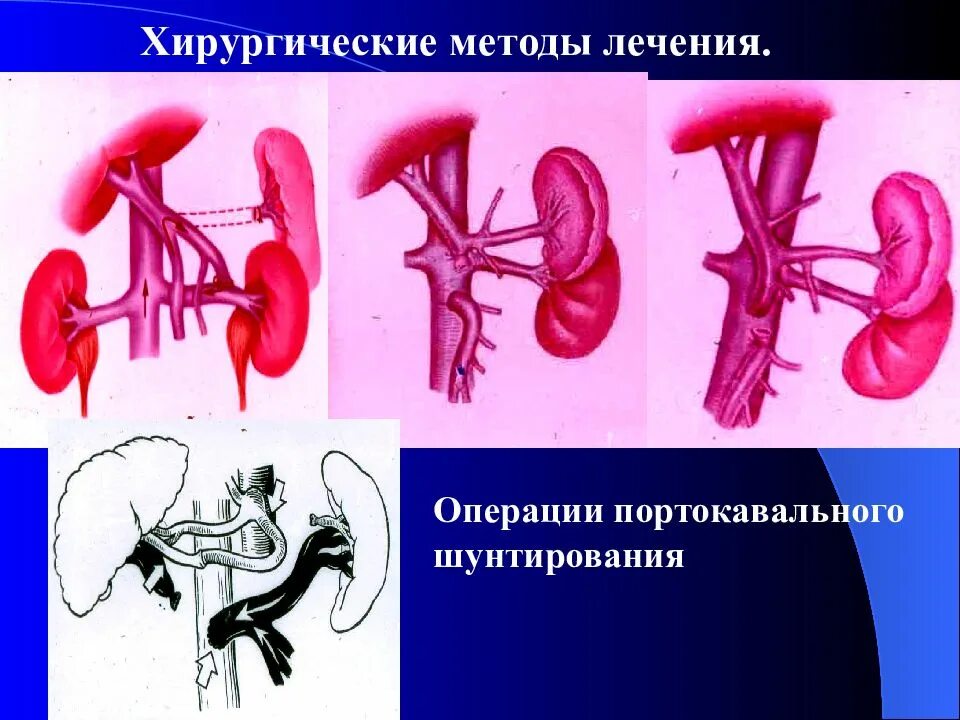 Операция гипертония. Шунтирующие операции при портальной гипертензии. Портокавальное шунтирование внепеченочной портальной гипертензии,. Портосистемное шунтирование при синдроме портальной гипертензии. Операции при портальной гипертензии.