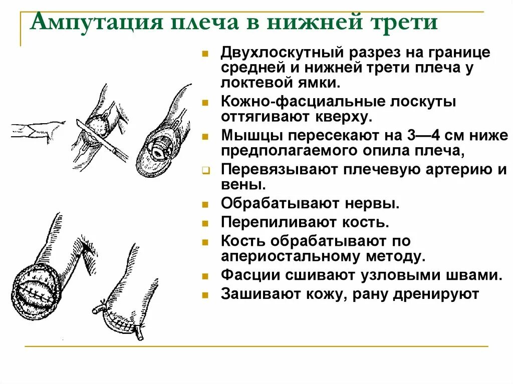 Принципы и основные этапы ампутации плеча. Ампутация плеча в средней трети. Ампутация фаланг пальцев кисти. Ампутация бедра двухлоскутным.