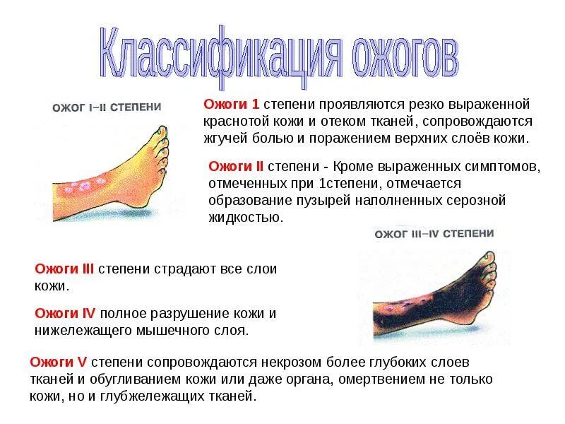 Ожоги бывают виды. Ожог первая степень термического ожога. Первая степень при ожоге 1 степени. Термический ожог 2 степени вид.