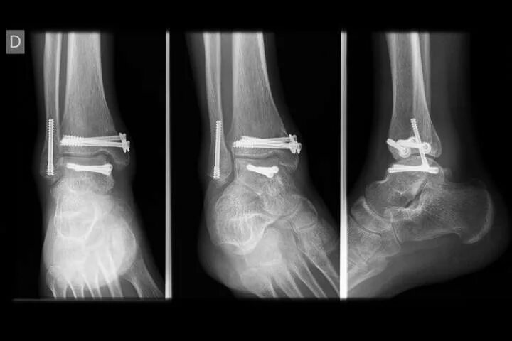 Перелом со смещением нужна операция. Чрезсиндесмозный перелом малоберцовой кости. Перелом лодыжки с остеосинтезом. Остеосинтез двухлодыжечный перелом. Остеосинтез таранной кости стопы.