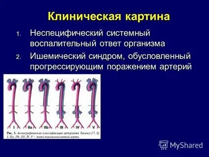 Болезнь такаясу клинические рекомендации
