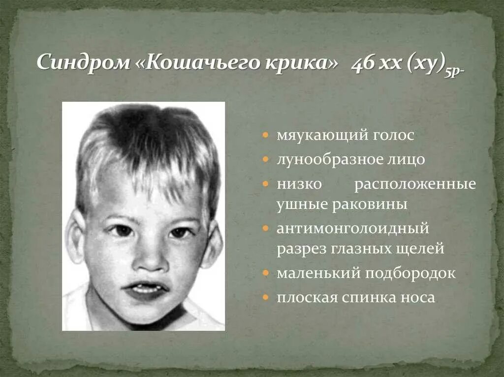 Причины кошачьего крика. Клинические проявления кошачьего крика. синдром кошачьего крика проявление. синдром кошачьего крика клиническая картина. 46,xx,5р - синдром &quot;кошачьего крика&quot;..