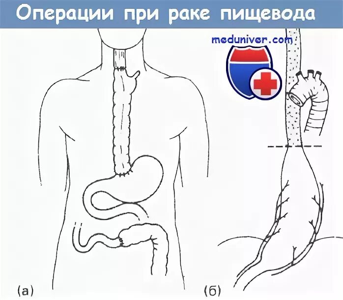 Операции на пищеводе. Операция Льюиса пищевод. Операция по Льюису на пищеводе.