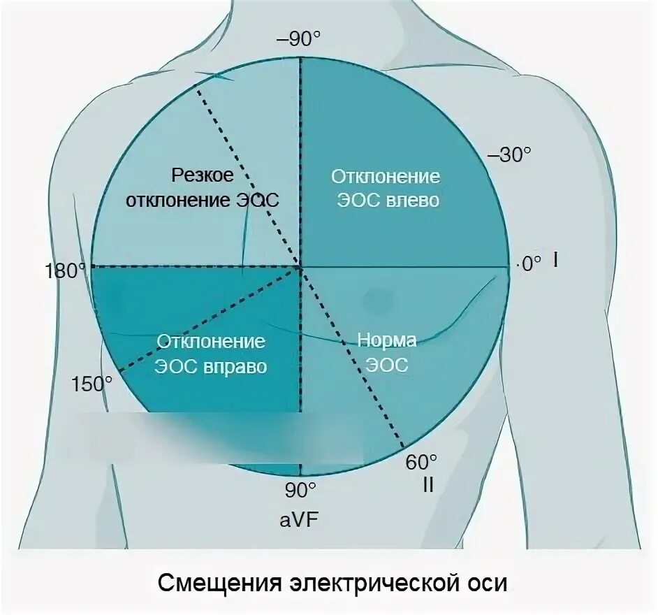 Смещение электрической оси сердца влево на ЭКГ. Ось сердца отклонена ЭКГ. Отклонение электрической оси сердца влево. Смещение электрической оси сердца. Сердце отклонено вправо