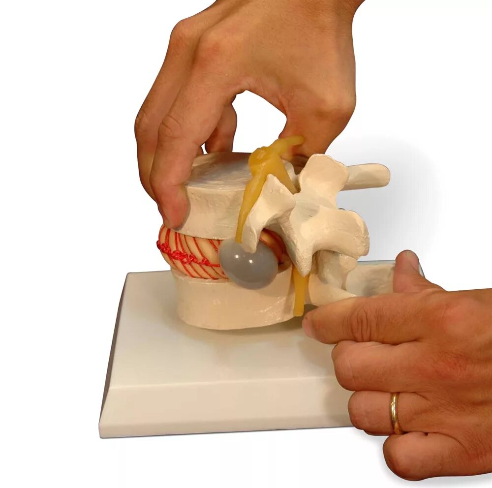Искусственный межпозвоночный диск. Грыжа позвоночника поясничного отдела. Замена межпозвоночного диска поясничного отдела. Протез межпозвоночного диска.