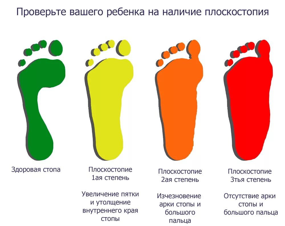 Плоскостопие у ребенка 6 лет отпечаток стопы. Плоскостопие 1, 2, 3 степени. Методы выявить степень плоскостопия. Плоскостопие 2 степени у ребенка 1.6. Внутри класса количество ног непостоянно