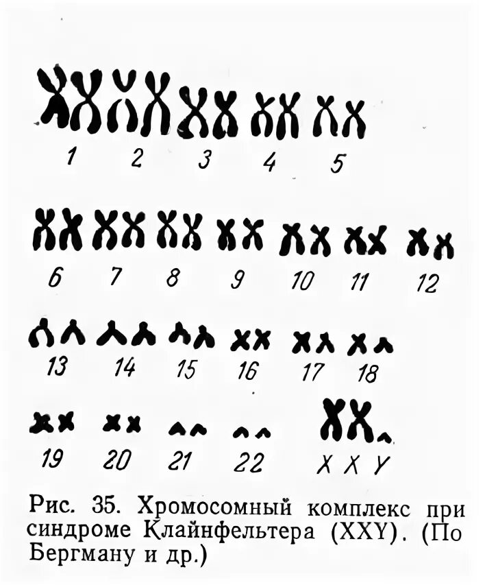 Xxy хромосома. Хромосомы при синдроме Клайнфельтера. Синдром Клайнфельтера кариограмма. Синдром Клайнфельтера набор хромосом. Синдром Клайнфельтера кариотип синдром.