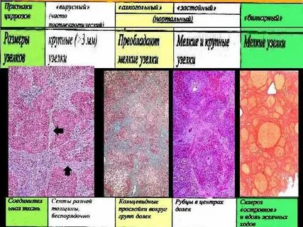 История болезни цирроз