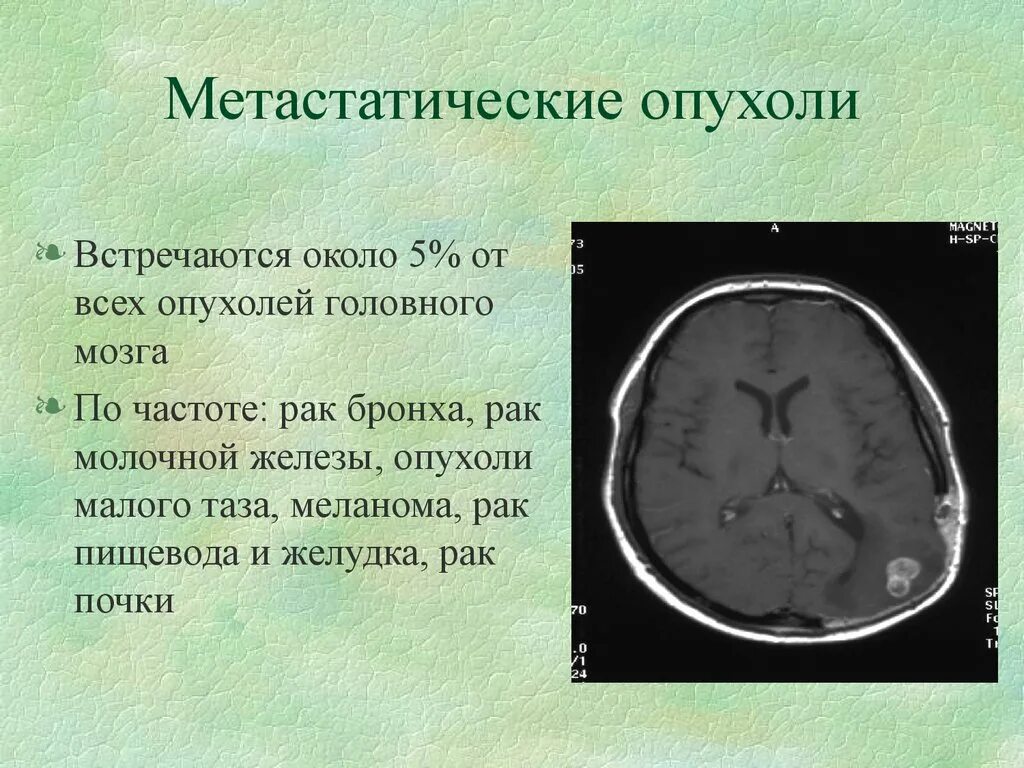 Метастазы меланомы в головной мозг мрт. Метастатические опухоли головного мозга. Опухоли головного мозга презентация. Отек головного мозга презентация.