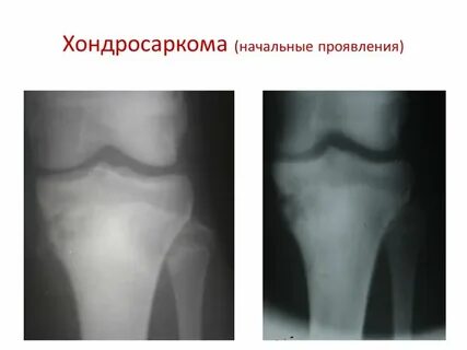 Хондросаркома
