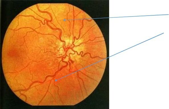 Гипертоническая ангиопатия и ретинопатия. Гипертоническая ангиопатия сосудов. Гипертоническая ангиопатия сетчатки. Гипертоническая ретинопатия Салюс. Сетчатки по гипертоническому типу