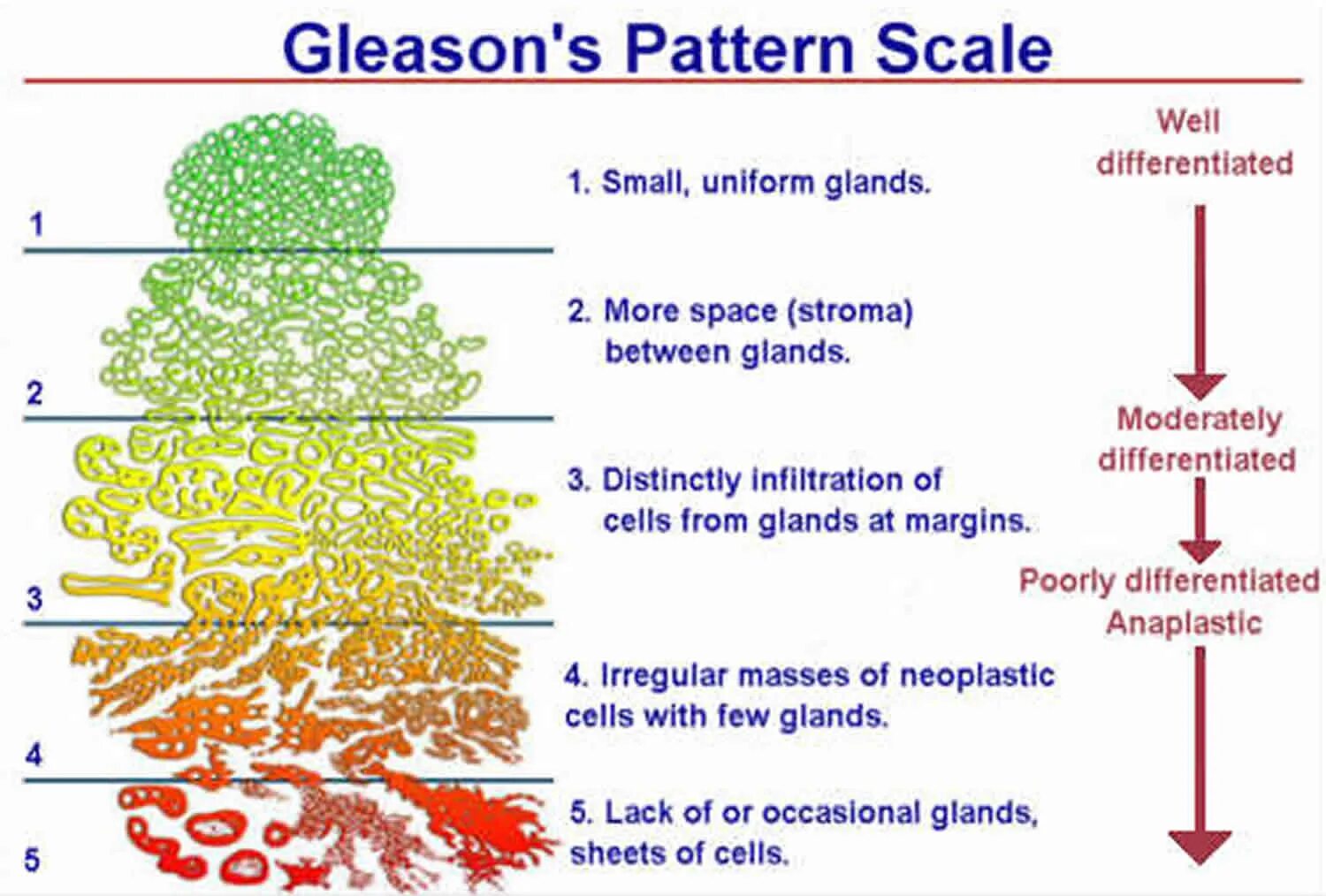 Глисон простата. Gleason score. Классификация по глисону. Шкала Глисона. Глиссон 3+3.