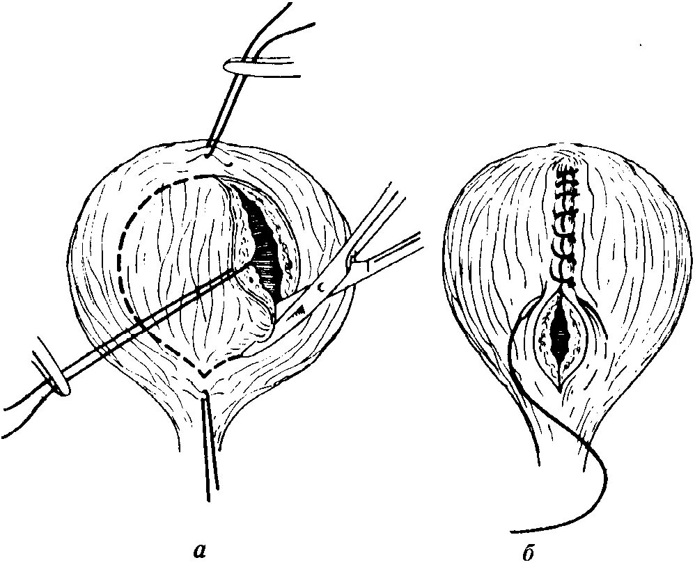 Ушивание разрывов. Трансвезикальная резекция мочевого пузыря. *Иссечение дивертикула мочевого пузыря. Дорсальная стенка мочевого пузыря. Мочевой пузырь повреждение ушивание.